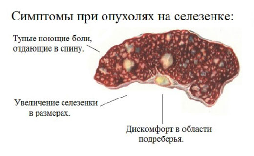 опухоль селезёнка