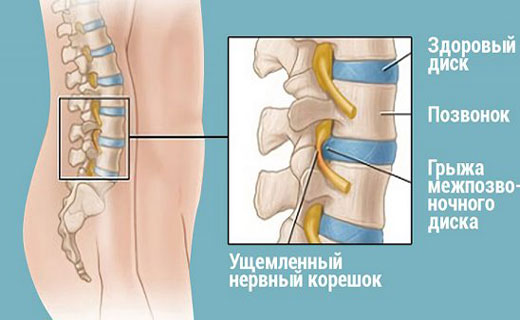 грыжа