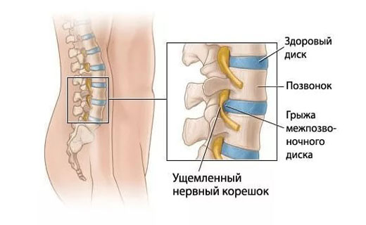 межпозвоночная грыжа