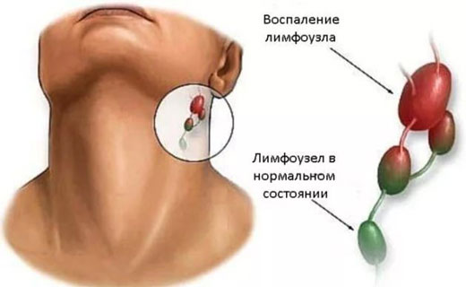 лимфоузлы за ухом