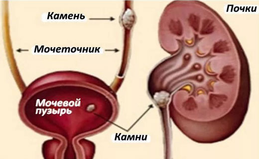 камни в почках