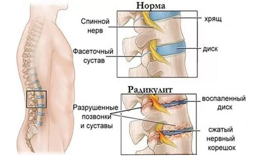 радикулит