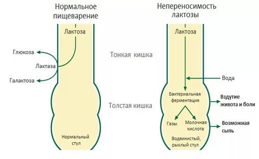невосприятие лактозы