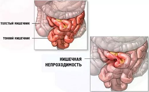 заворот кишки