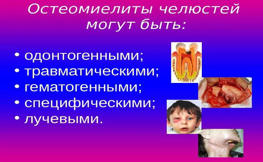 остеомиелит