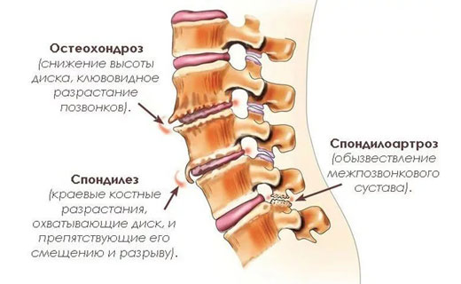 спондилез