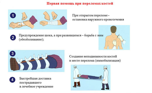 доврачебная помощь при переломе