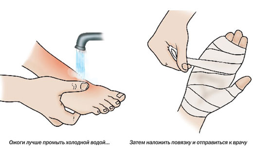 доврачебная помощь при ожогах