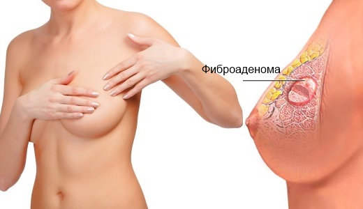 Лечение фиброаденомы способами народной медицины