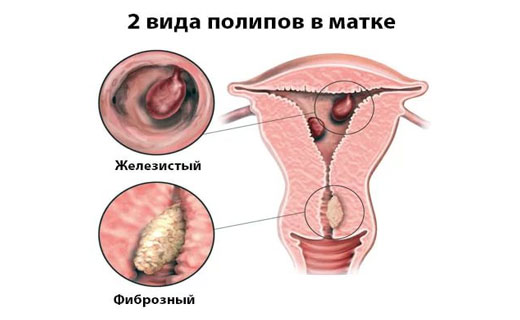 железисто-фиброзный полип