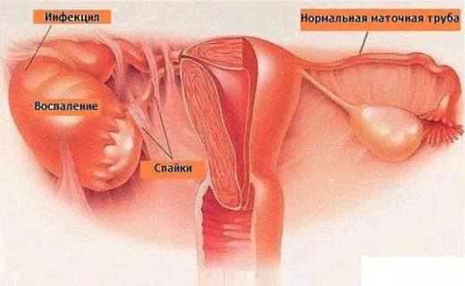 воспаление придатков