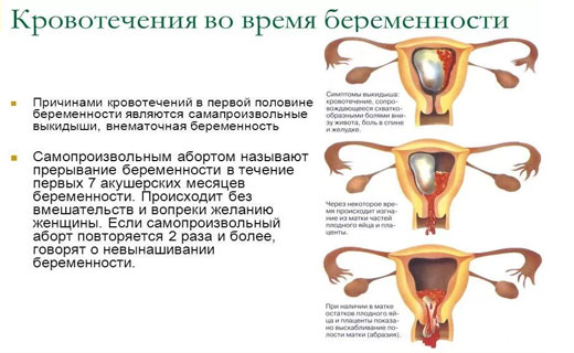 кровотечение при беременности