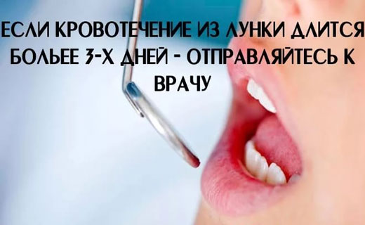 кровотечение десен