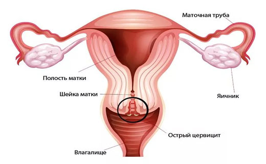 кровотечение во время акта