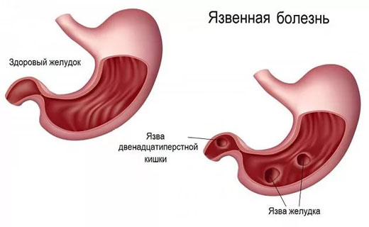 кровотечение при язве