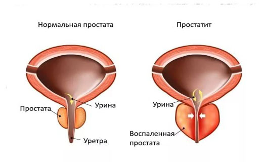 простатит