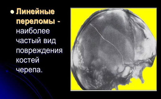 линейный перелом