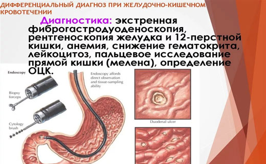 желудочное кровотечение