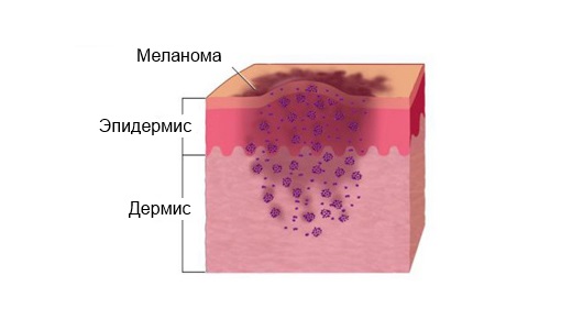 Меланома лечение способами народной медицины