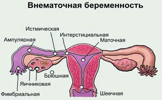 внематочная беременность
