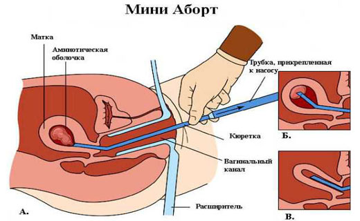 мини-аборт