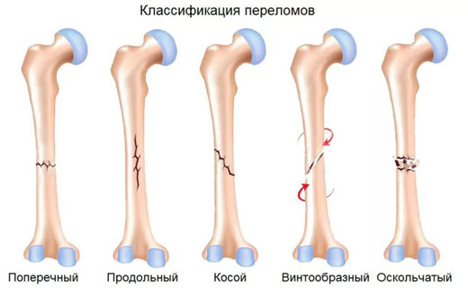 множественный перелом