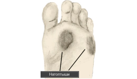 Лечение натоптышей способами народной медицины
