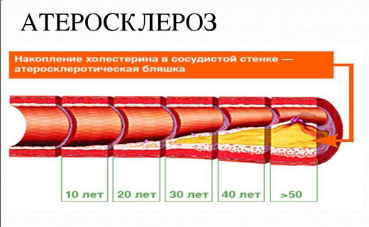 атеросклероз