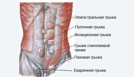 Лечение паховой грыжи способами народной медицины