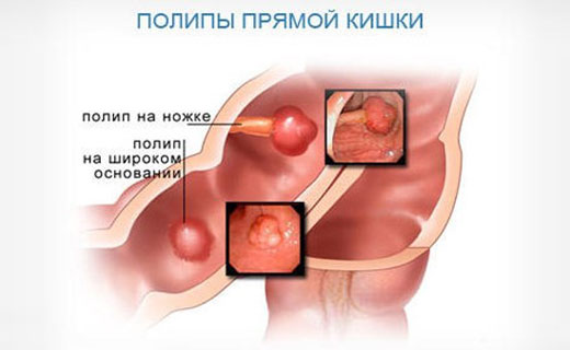 полип прямой кишки