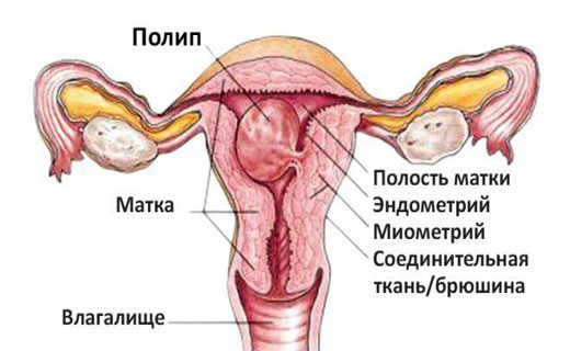 полип в матке
