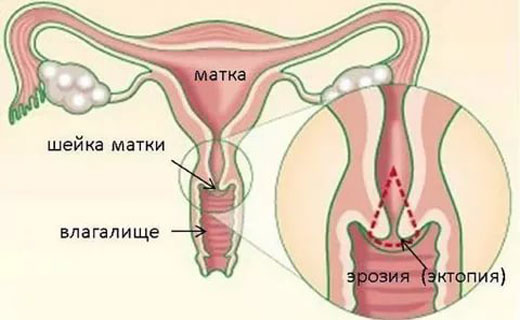 эррозия шейки матки