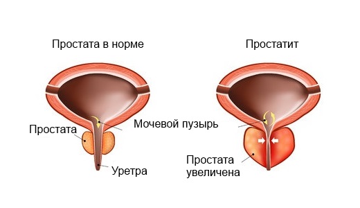 Браслет от простатита