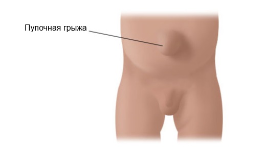 Лечение пупочной грыжи способами народной медицины
