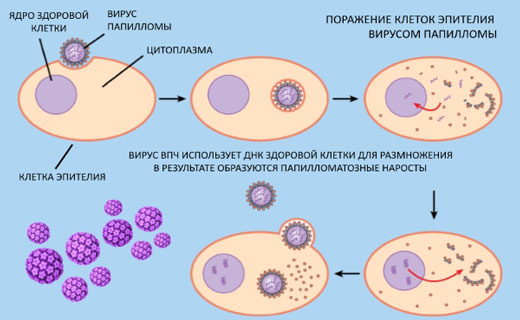 вирус папалломы