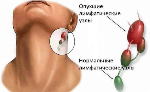 увеличение лимфоузлов