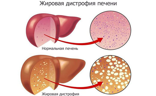 жировая дистрофия
