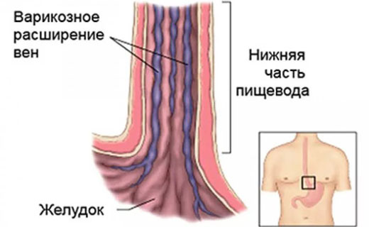 варикозное кровотечение
