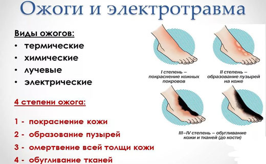 виды ожогов