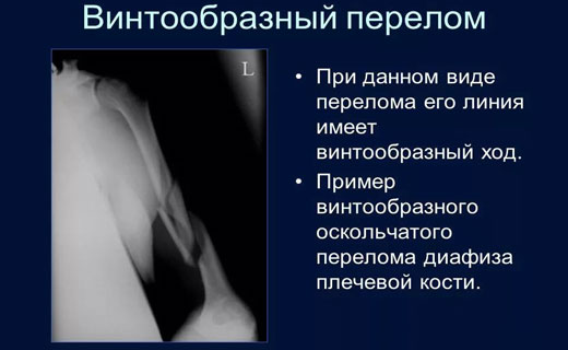 винтообразный перелом