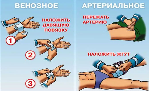 временная остановка крови