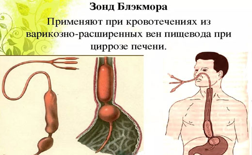 зонд блекмора
