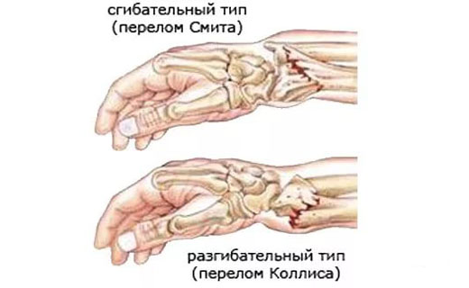 закрытый перелом лучевой кости