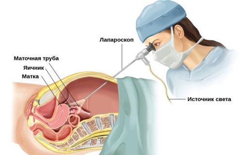 лапароскопия