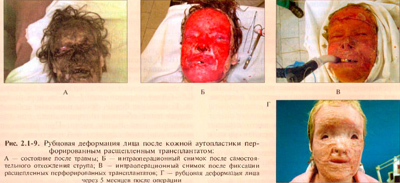 Лечение лямблиоза у детей схема отзывы
