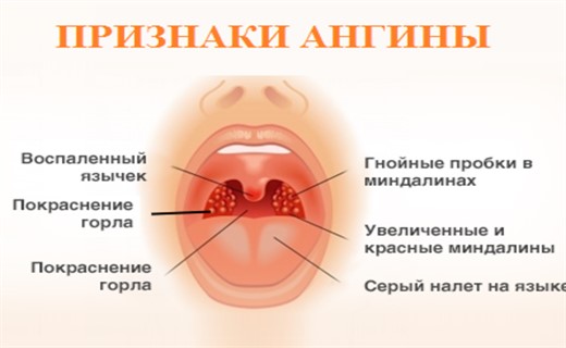 Первые признаки ангины