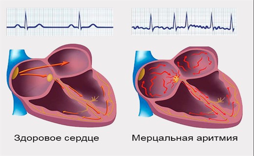 Мерцательная аритмия сердца