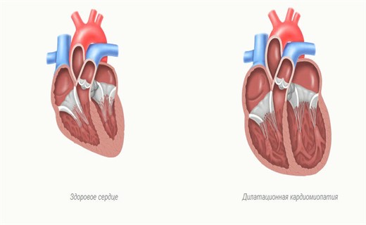 Признаки дилатационной кардиомиопатии