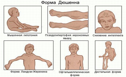 Дистрофия мышц у детей