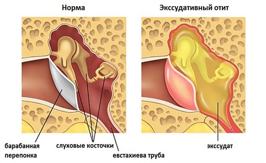 Экссудативный отит уха